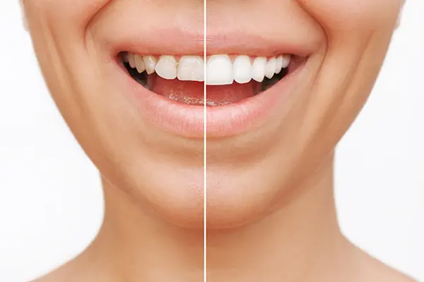 Veneers at Dr. Francine Abad