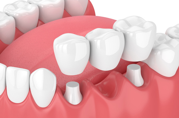 Invisalign® 3D rendering of dental bridges