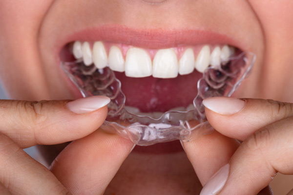 Close up of a woman putting clear aligner on her teeth