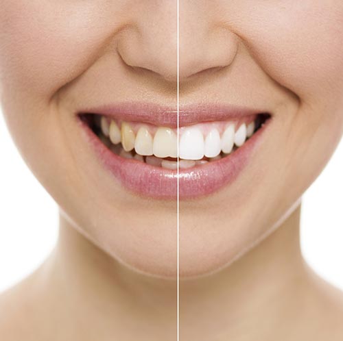 Teeth Whitening at Portola Smiles